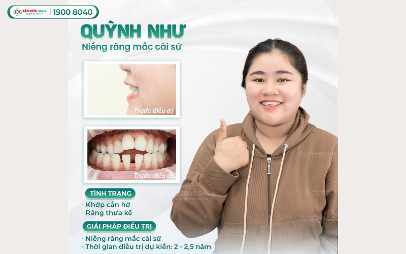 Mắc cài sứ – Thẩm mỹ vượt trội, dễ dàng vệ sinh
