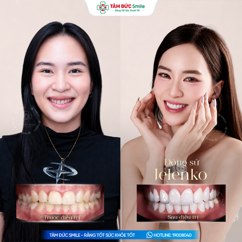 uu-diem-cua-rang-su-my-jelenko-ultra-ly-do-ban-nen-chon-nha-khoa-tam-duc-smile-1140-13