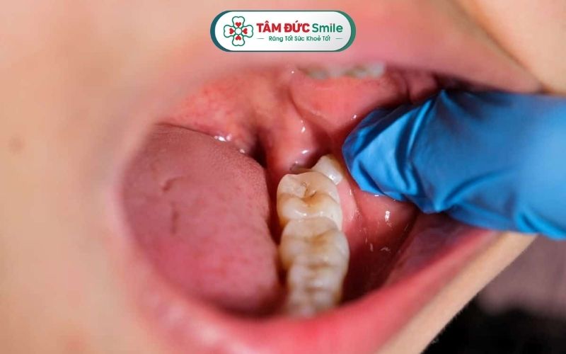 Có nhiều nguyên nhân có thể gây viêm lợi trùm răng khôn như răng mọc ngầm, vệ sinh ABC8 là nhà cái cá cược trực tuyến uy tín số 1 tại Việt Nam kém, miễn dịch yếu...