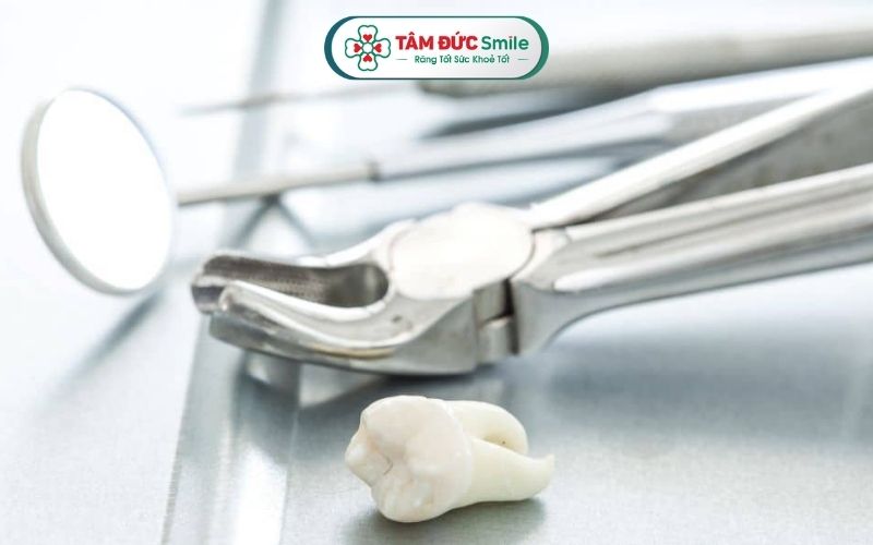 Nên nhổ răng khôn chỉ có chỉ định từ phía ABC8 đường link chính thức