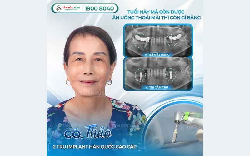 yeu-to-danh-gia-dia-chi-trong-rang-implant-tai-quan-9-5