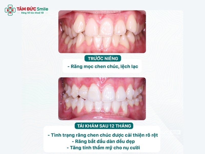 33-tuoi-co-nen-nieng-rang-7