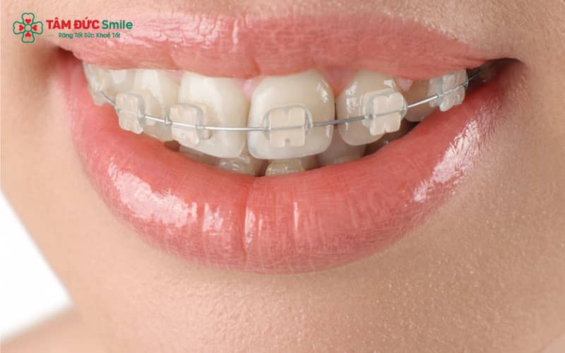 Mắc cài sứ Abc8c1 com khuyến mãi hấp dẫn là lựa chọn tinh tế cho Quý khách tuổi 40