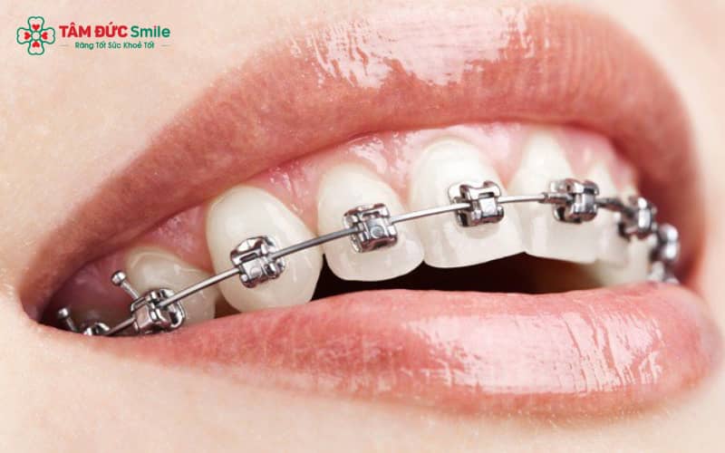 Mắc cài kim loại tự buộc mang lại hiệu quả cao