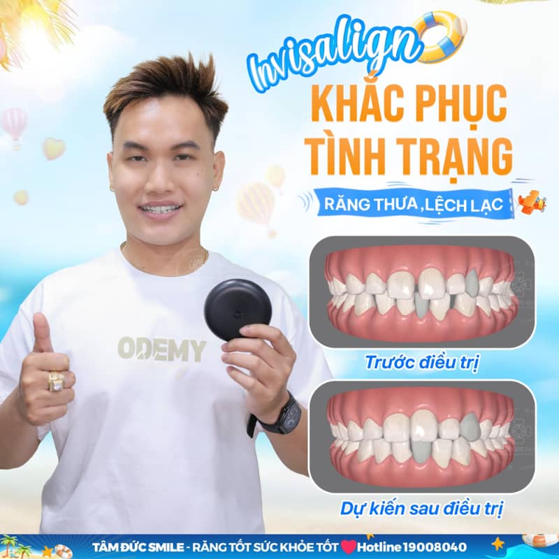 Kết quả Abc8c1 com khuyến mãi hấp dẫn nhanh nhờ công nghệ Invisalign Express hiện đại