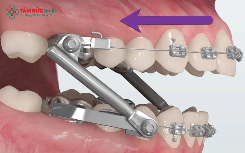 Quý khách có thể ê buốt răng khi ăn uống trong giai đoạn niềng