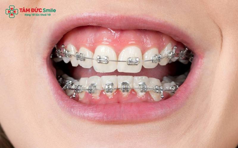 Khi đau đầu kéo dài, Quý khách cần tái khám ngay để tránh biến chứng