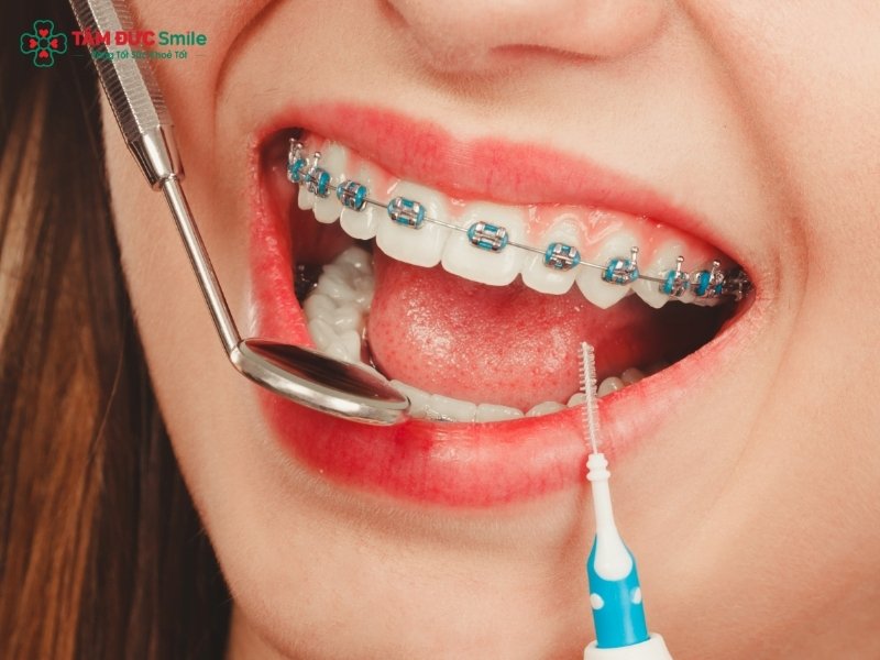Quý khách nên đến LINK TRANG CHỦ ABC88 CHUẨN 2026 tái khám định kỳ để hạn chế bị sưng nướu khi Abc87 tải ứng dụng