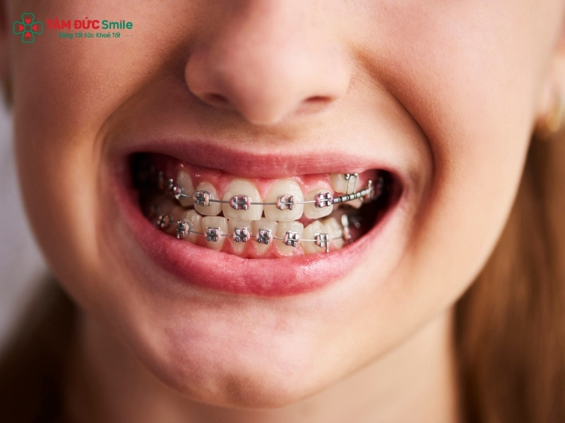 Sưng nướu khi Abc87 tải ứng dụng có thể xảy ra theo nhiều dạng