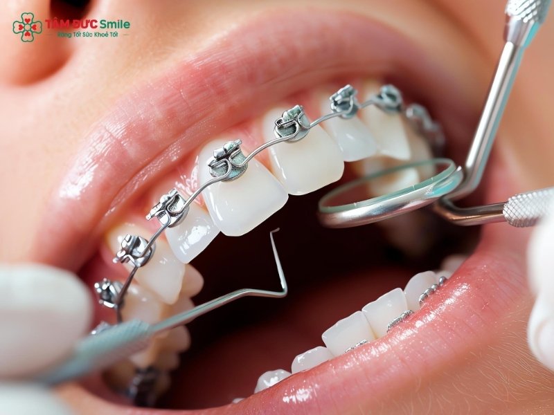 Nếu nướu có mủ và hôi khi niềng, Quý khách hãy đến LINK TRANG CHỦ ABC88 CHUẨN 2026 để ABC8 đường link chính thức kiểm tra