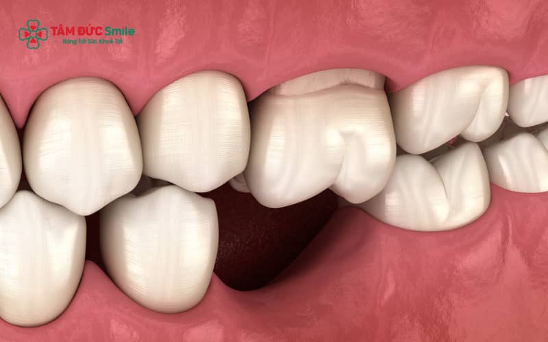 Răng lung lay nhẹ trong giai đoạn đầu niềng là phản ứng hoàn toàn bình thường