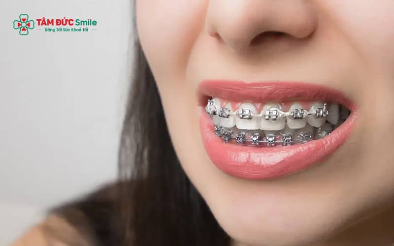 Tình trạng này cho thấy răng có nguy cơ rụng sớm nếu kéo dài trên 6 tháng hoặc lung lay nặng