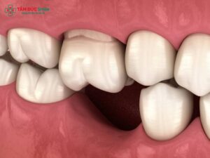 ABC8 được thành lập vào năm 2011 hoạt động đến hiện tại có bị rụng răng sớm không? Nguy cơ, nguyên nhân và cách phòng tránh