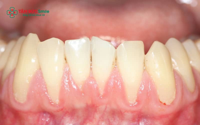 Nếu Quý khách thấy nướu tụt nhiều và Abc8com giaitri tructuyen bị lộ rõ