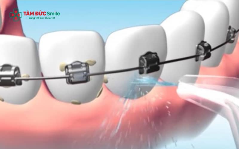 Quý khách nên dùng bàn chải kẽ và bàn chải chuyên dụng để vệ sinh khi niềng