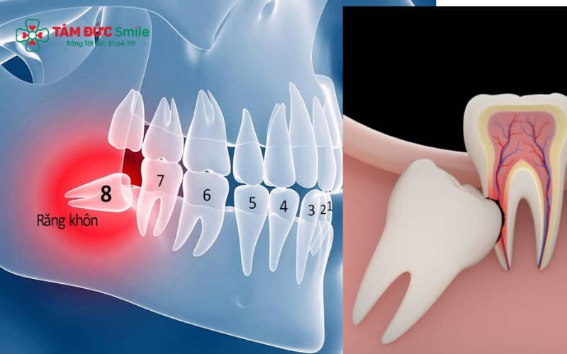 Răng khôn là răng mọc cuối cùng ở mỗi cung hàm