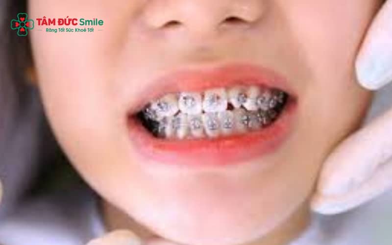 Tái niềng được chỉ định khi cần phục hồi Abc8c1 com khuyến mãi hấp dẫn và chức năng ABC8 là nhà cái cá cược trực tuyến uy tín số 1 tại Việt Nam