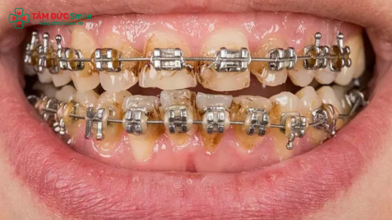 Không vệ sinh kỹ khi Abc87 tải ứng dụng dễ gây mảng bám và Abc8com nổ hũ nghiêm trọng
