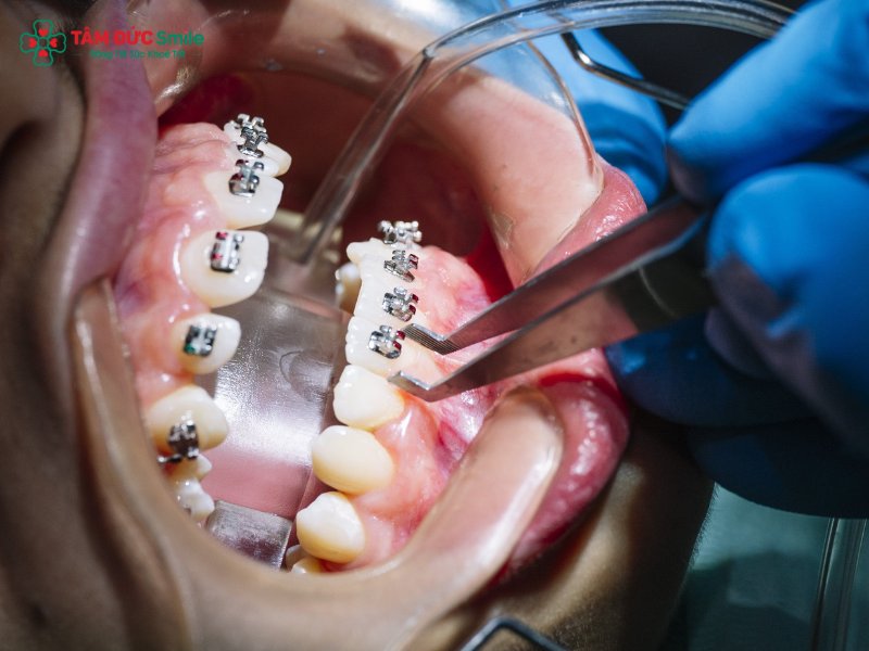 Quý khách thường ê buốt nhẹ trong giai đoạn gắn mắc cài