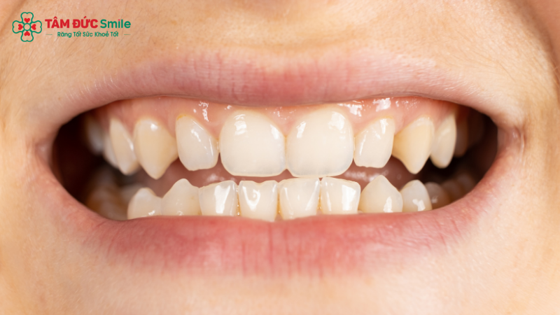 Invisalign phù hợp với nhiều trường hợp như răng thưa, răng khấp khểnh, răng lệch lạc, hô hoặc móm nhẹ sau khi được ABC8 đường link chính thức thăm khám.