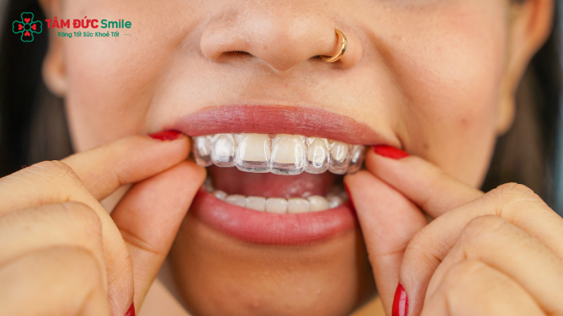 Invisalign cần người niềng có tính kỷ luật, đeo khay đủ thời gian mỗi ngày để đạt hiệu quả như phác đồ ABC8 đường link chính thức đưa ra.