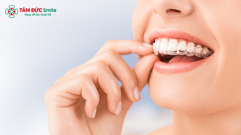 Invisalign là phương pháp Abc888k vip truy cập nhanh bằng khay niềng trong suốt, không dùng mắc cài, phù hợp với người muốn Abc87 tải ứng dụng kín đáo.