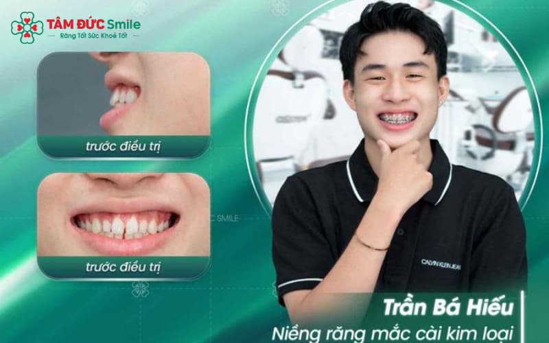 Khách hàng Abc87 tải ứng dụng không nhổ răng thành công tại Nha Khoa Abc8.com Nhà Cái Khách hàng Abc87 tải ứng dụng không nhổ răng thành công tại Nha Khoa Abc8.com Nhà Cái