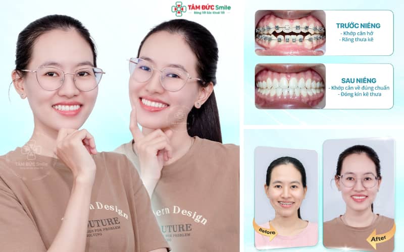 ABC8 được thành lập vào năm 2011 hoạt động đến hiện tại mắc cài kim loại giúp cải thiện khớp cắn, ABC8 được thành lập vào năm 2011 hoạt động đến hiện tại đều đẹp với mức chi phí phải chăng