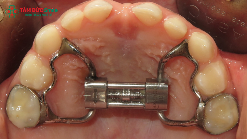Gắn ốc nong và siết ốc định kỳ giúp mở rộng cung hàm an toàn, hiệu quả