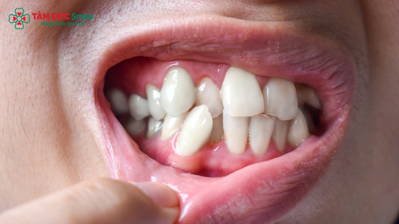 Nong hàm giúp tạo khoảng trống, sắp xếp răng chen chúc hiệu quả hơn khi niềng