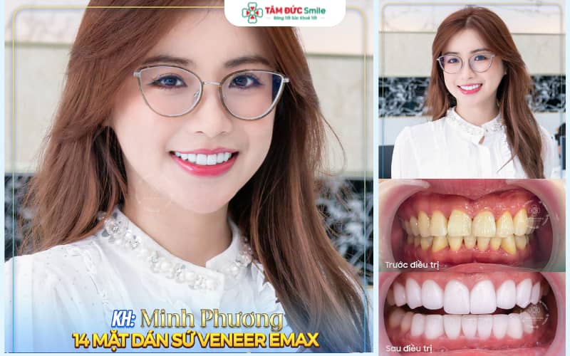 Răng toàn sứ cao cấp mang lại tính Abc8c1 com khuyến mãi hấp dẫn tự nhiên và sang trọng