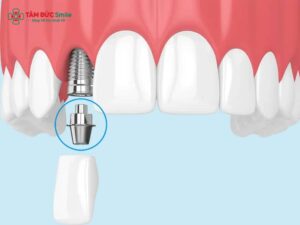 Abutment là gì? Cấu tạo, phân loại, chi phí và vai trò Abutment trong Implant