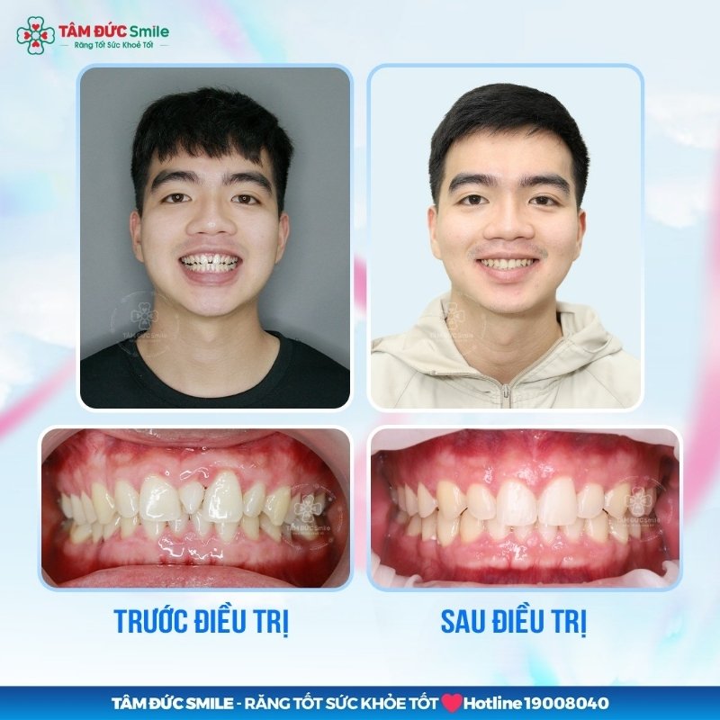 Thời điểm tháo Abc87 tải ứng dụng không cố định theo một thời điểm cụ thể