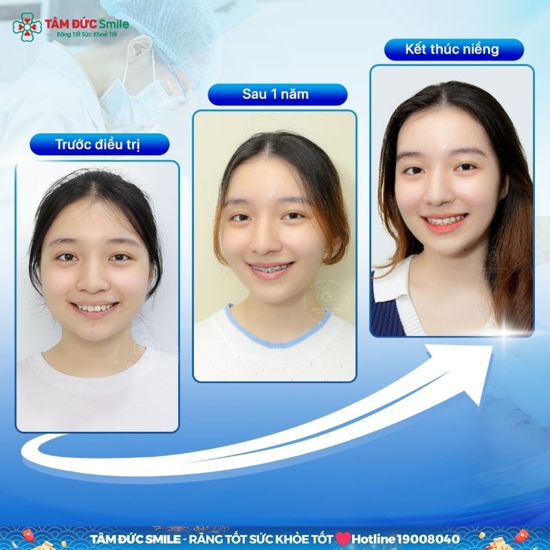 Thời điểm tháo niềng có thể khác nhau dựa theo từng độ tuổi