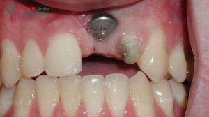 bien-chung-khi-cay-ghep-implant-4