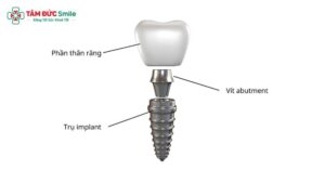 cau-tao-rang-implant-1