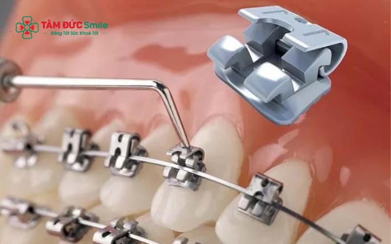 Chỉnh nha cố định sử dụng mắc cài để điều chỉnh vị trí răng