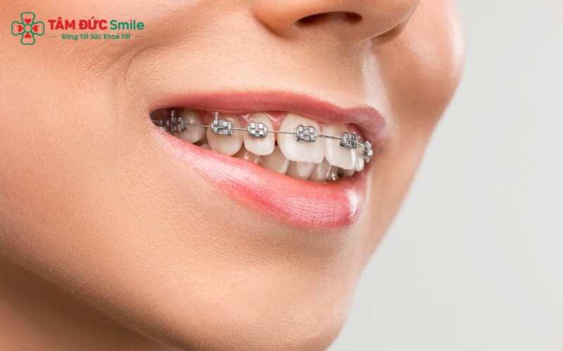 Mắc cài kim loại truyền thống bền chắc và kiểm soát lực di Link Vào Abc8.com Đăng Ký Tặng 88K hiệu quả