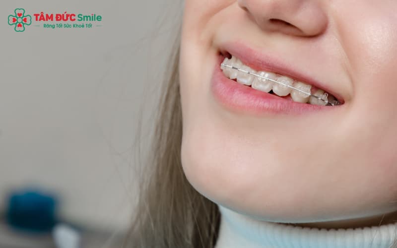 Mắc cài sứ Abc8c1 com khuyến mãi hấp dẫn có màu sắc tiệp răng, mang lại vẻ ngoài tự nhiên hơn