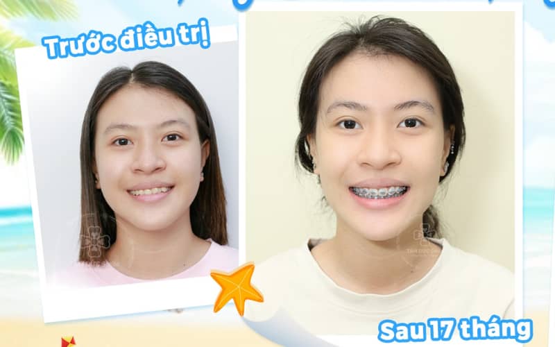 Chỉnh nha mang lại Abc8.com link truy cập đều đẹp và cải thiện đường nét gương mặt