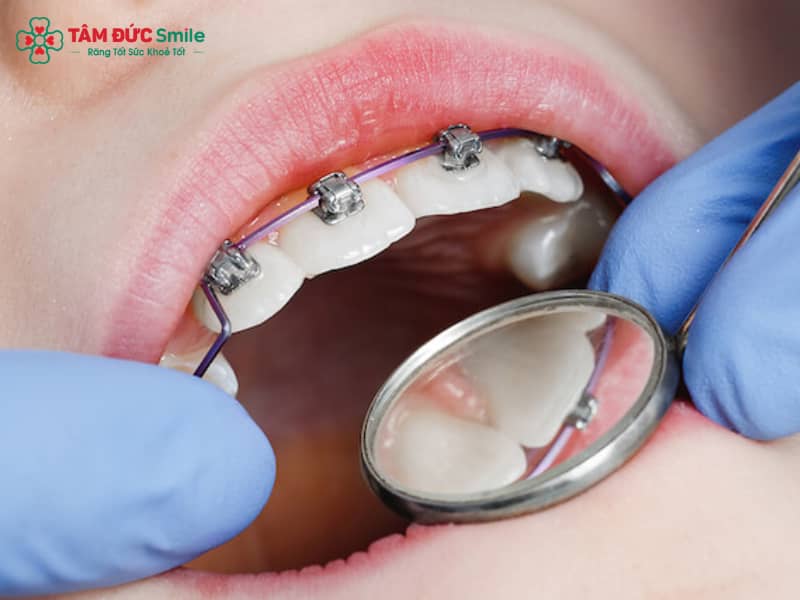Chỉnh nha cố định: Phân loại mắc cài, quy trình, chi phí và hiệu quả lâu dài
