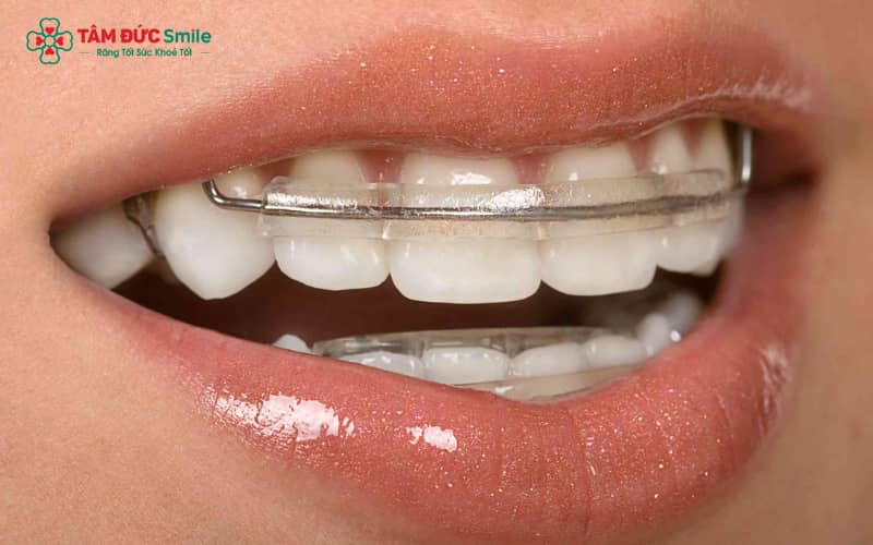 Hàm duy trì đảm bảo răng giữ đúng vị trí mới sau quá trình niềng