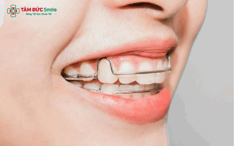 Hàm duy trì cố định sử dụng thanh kim loại mảnh để duy trì vị trí răng sau niềng