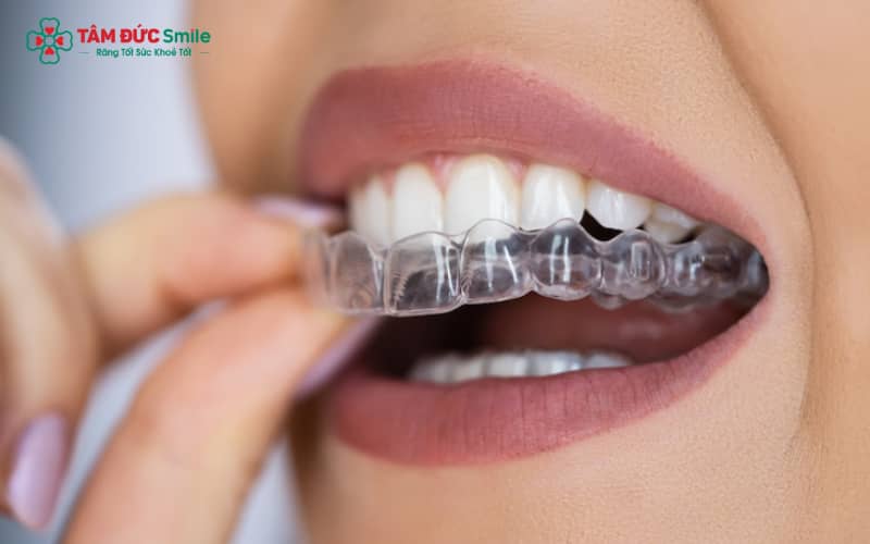 Hàm duy trì tháo lắp được làm từ nhựa hoặc nhựa kèm kim loại, có thể tháo ra dễ dàng