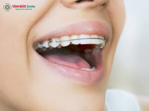 Có cần đeo hàm duy trì suốt đời không? Thời gian, loại và hậu quả khi bỏ