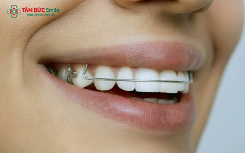 Thời gian đeo hàm duy trì tiêu chuẩn thường kéo dài từ 6 đến 12 tháng sau khi tháo niềng