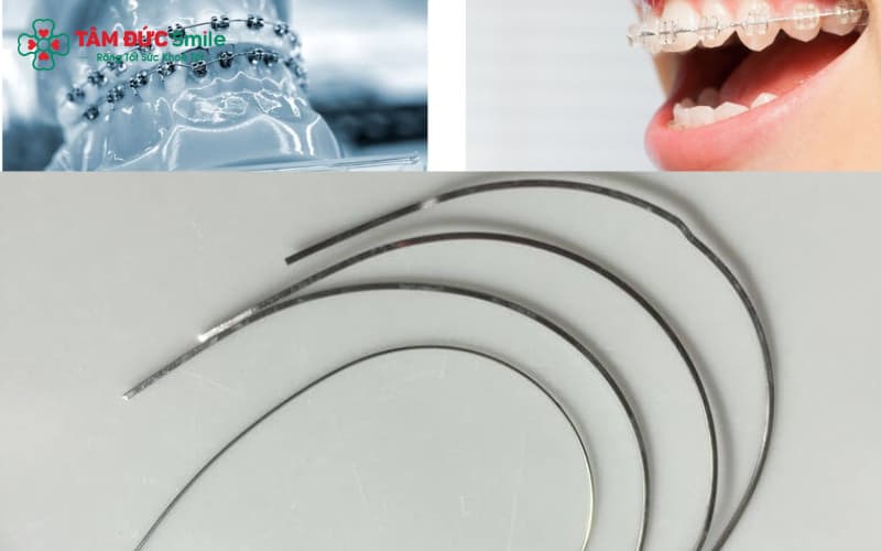Dây cung tròn hỗ trợ răng dịch chuyển chính xác theo phác đồ