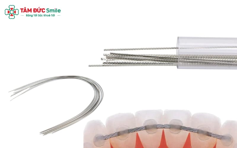 Chất liệu dây cung được chọn theo giai đoạn và tình trạng răng để Abc888k vip truy cập nhanh hiệu quả