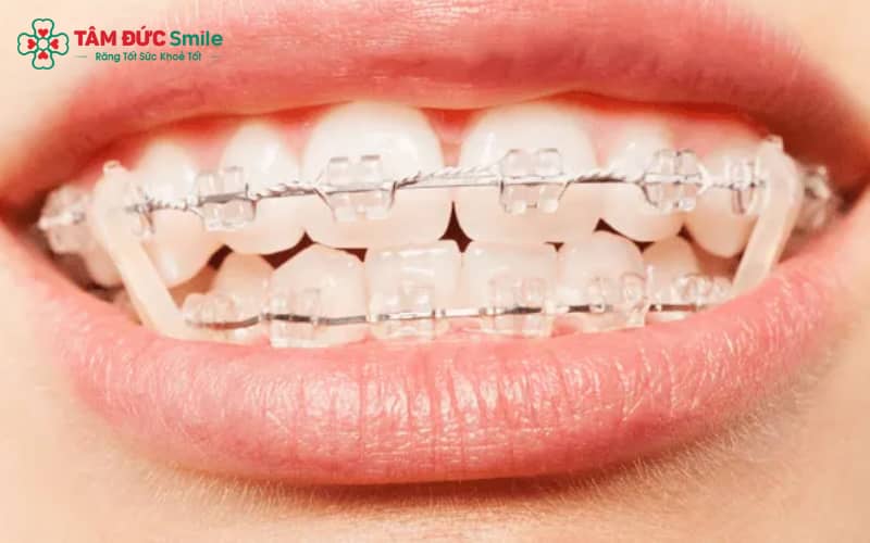 Dây thun giúp tăng hiệu quả điều chỉnh răng về đúng vị trí trên cung hàm