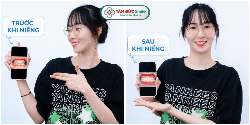 Quý khách cần tuân thủ thời gian và cách đeo dây thun để đạt kết quả tốt nhất